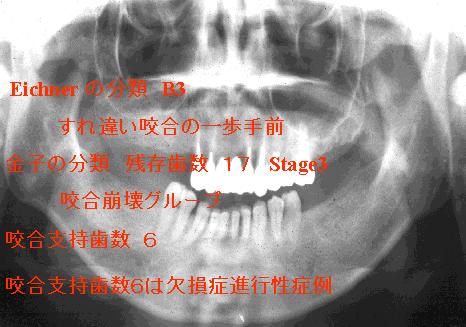 インプラント補綴による咬合再構成 咀嚼障害を主訴に来院されました 咬合の崩壊をくい止め 咀嚼機能の回復を計るため インプラント補綴を計画しました 右上顎臼歯部に３本 左右下顎臼歯部にそれぞれ２本インプラントを配置しました プロビィ